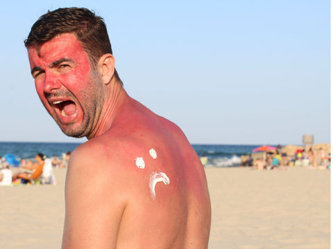 Using a Natural Sunburn Ointment